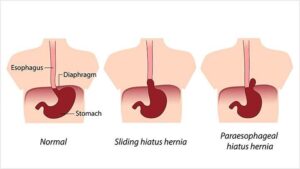 What Is a Hiatal Hernia?