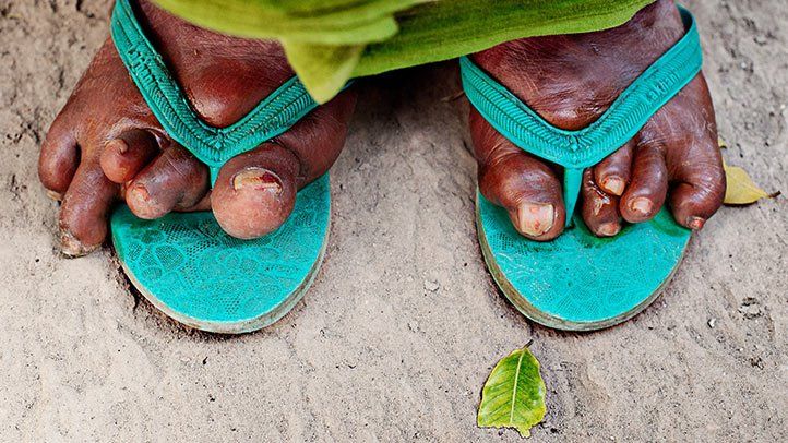 What Is Leprosy?
