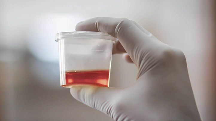 Why Is There Blood in My Urine (Hematuria)?